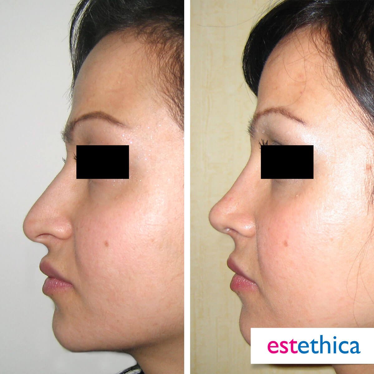 Rhinoplasty Turkey Before After - Open Rhinoplasty