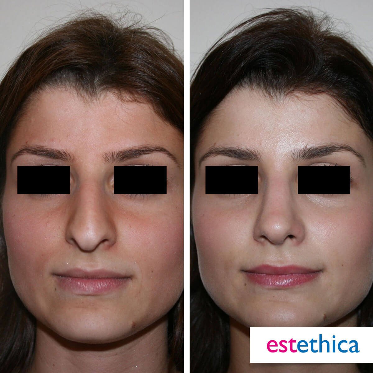 Rhinoplasty Turkey Before After - Profile Enhancement