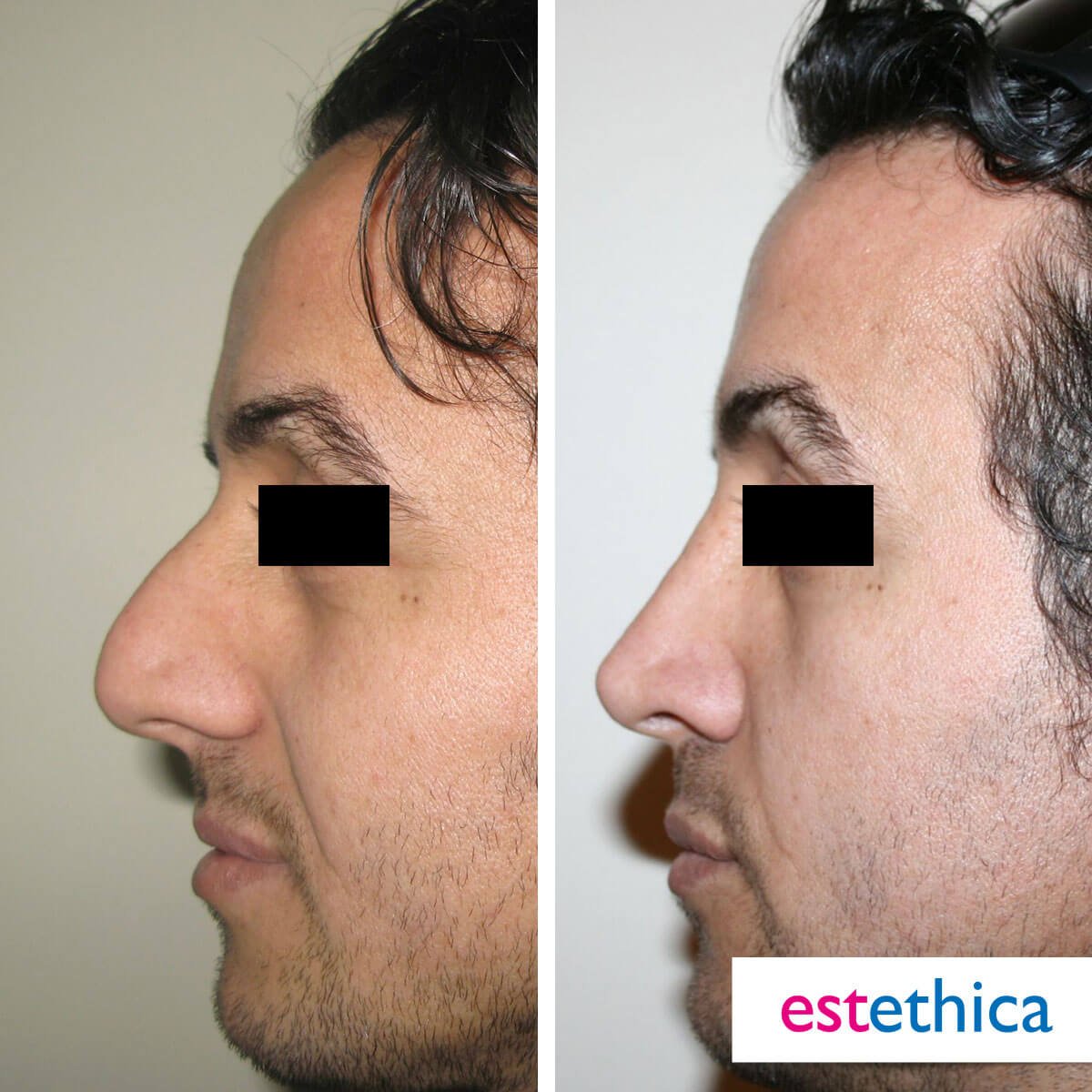 Rhinoplasty Turkey Before After - Asymmetry Correction