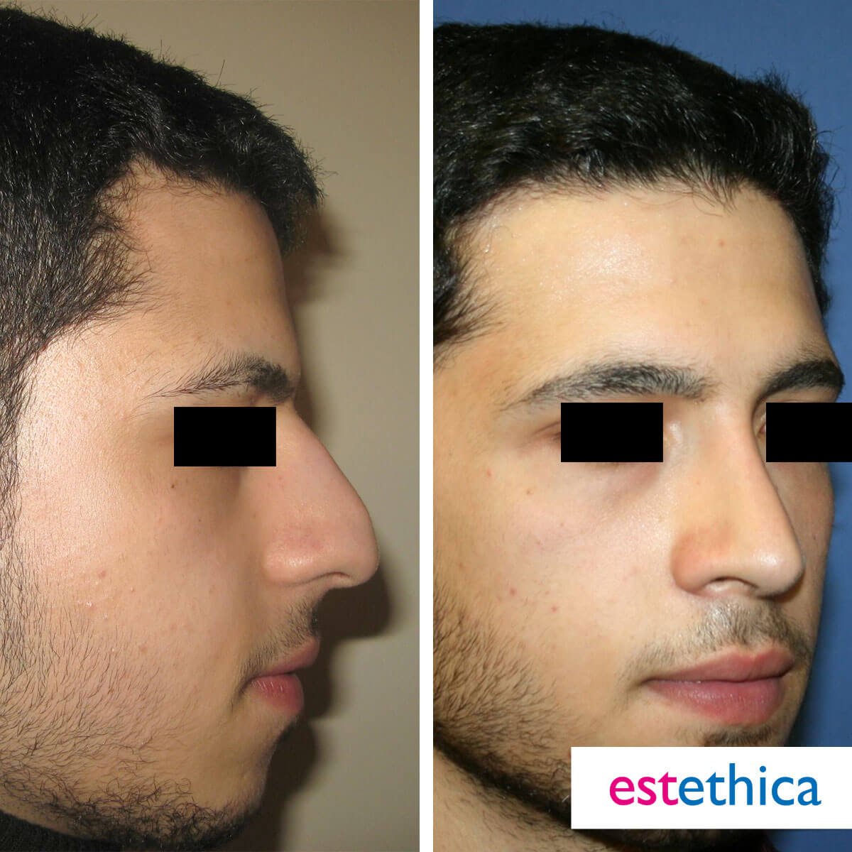 Rhinoplasty Turkey Before After - Nasal Narrowing