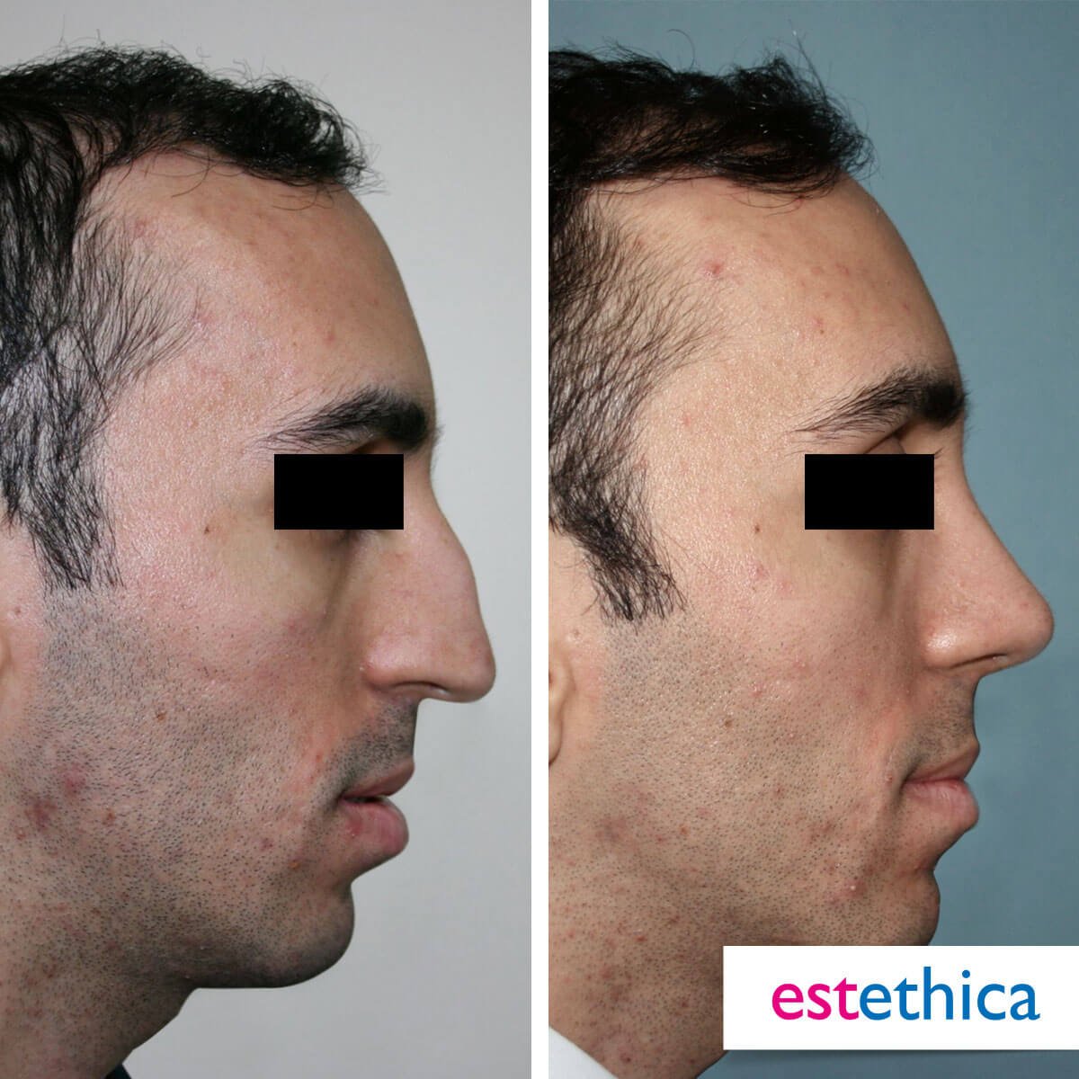 Rhinoplasty Turkey Before After - Droopy Tip
