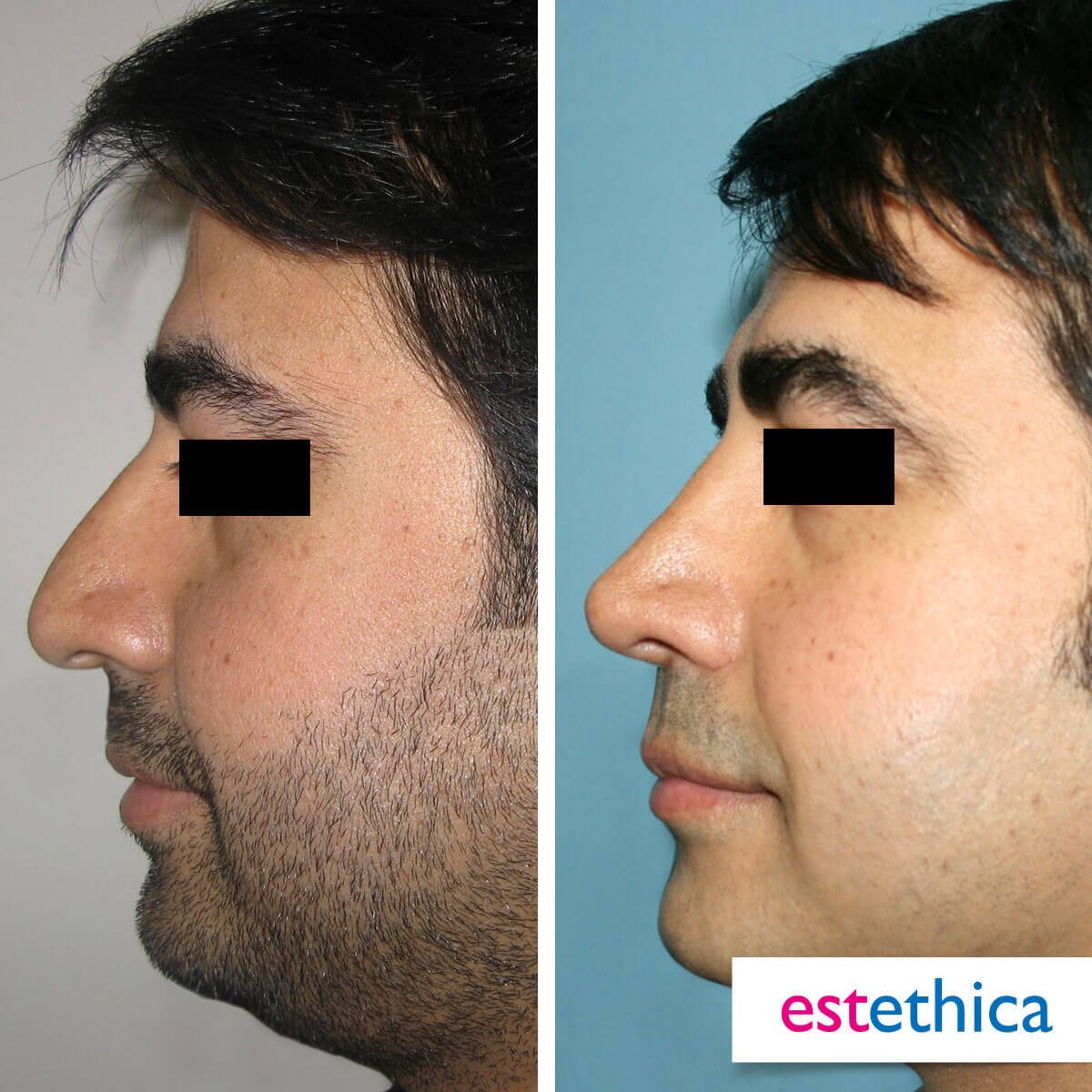 Rhinoplasty Turkey Before After - Wide Nose