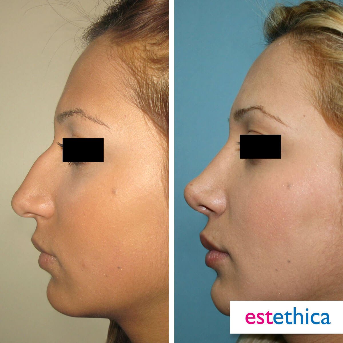 Rhinoplasty Turkey Before After - Complete Rhinoplasty