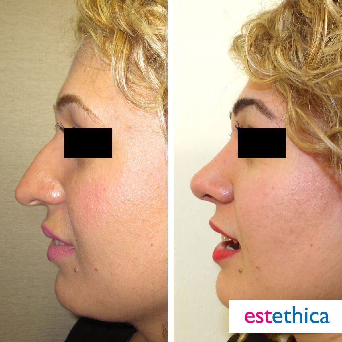 Rhinoplasty Turkey Before After - Tip Plasty
