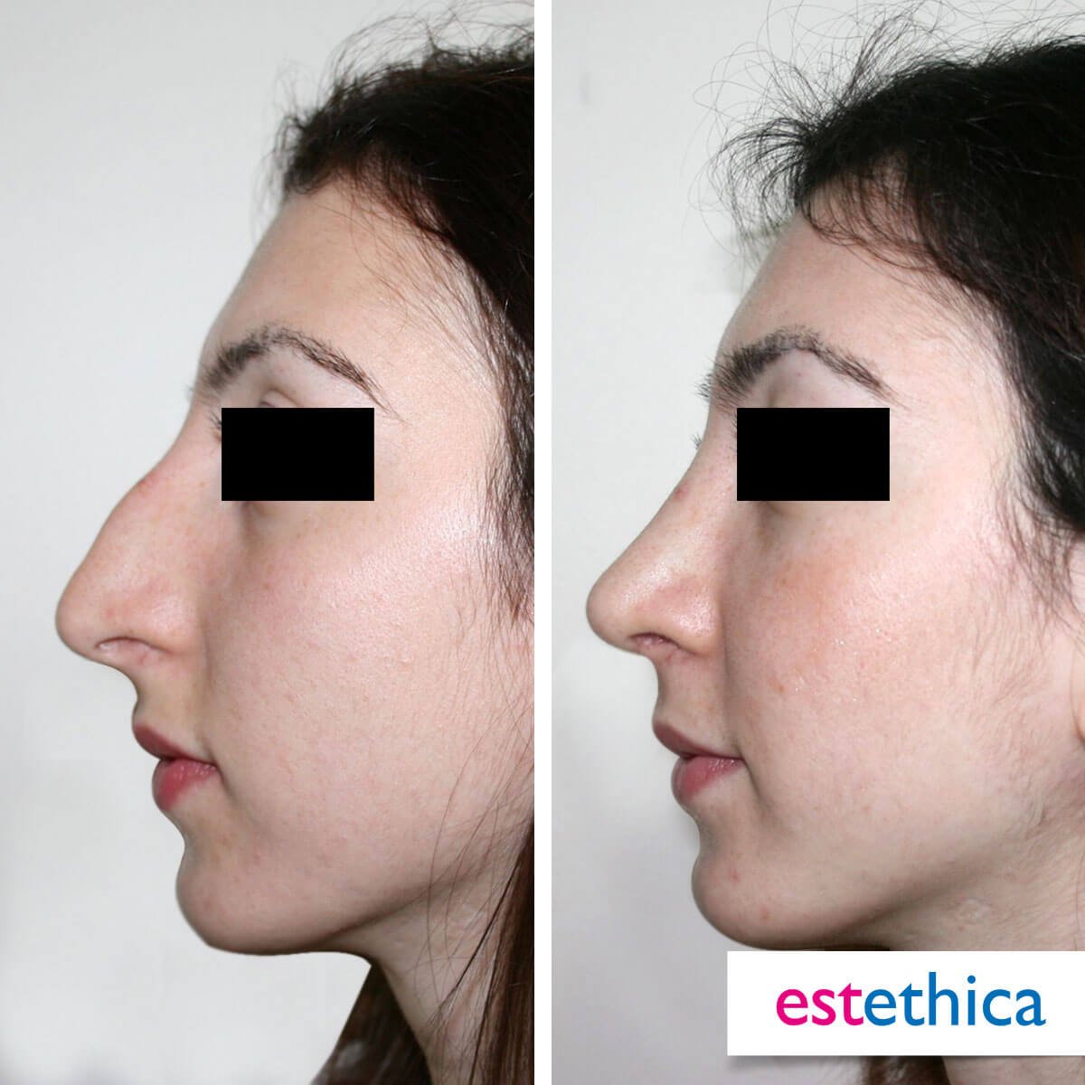 Rhinoplasty Turkey Before After - Closed Rhinoplasty