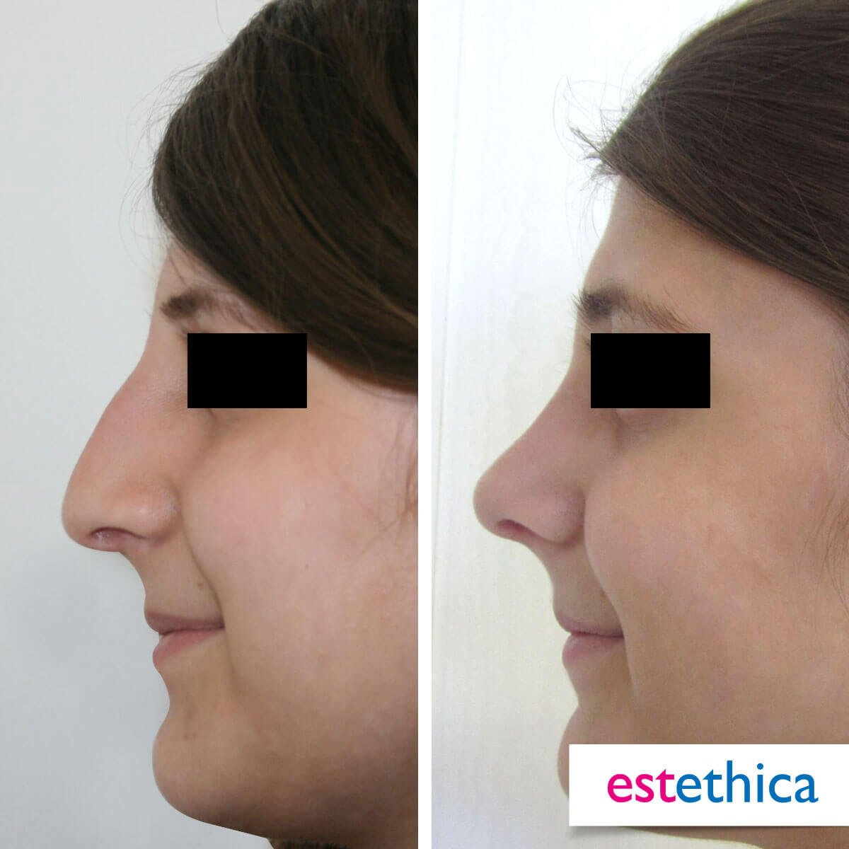 Rhinoplasty Turkey Before After - Hump Removal