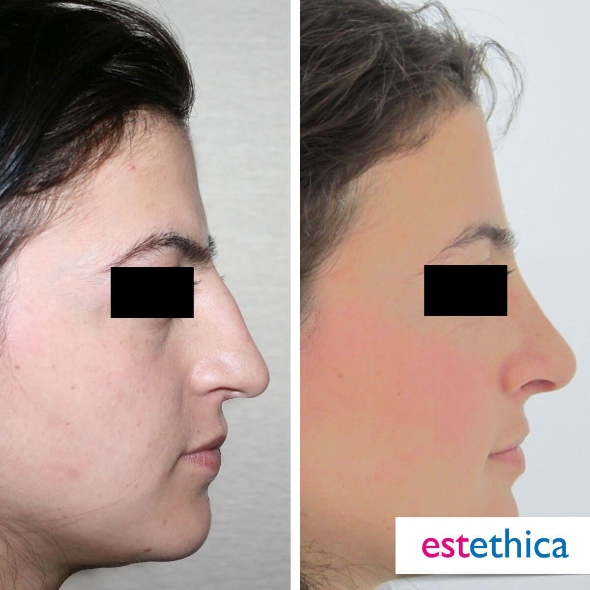 Rhinoplasty Turkey Before After - Ethnic Rhinoplasty
