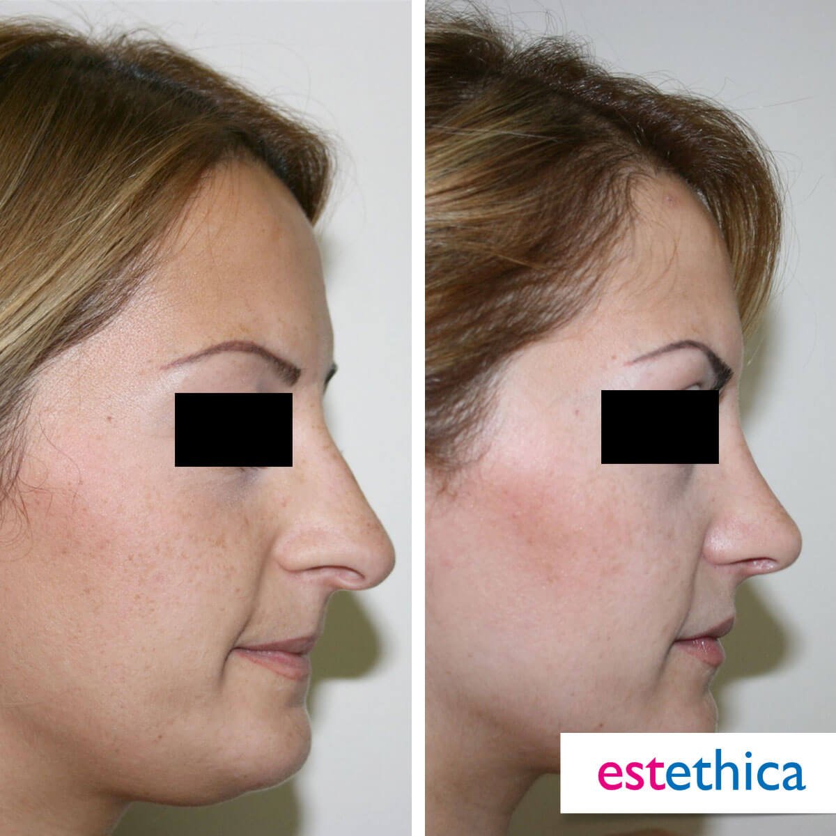 Rhinoplasty Turkey Before After - Revision Rhinoplasty