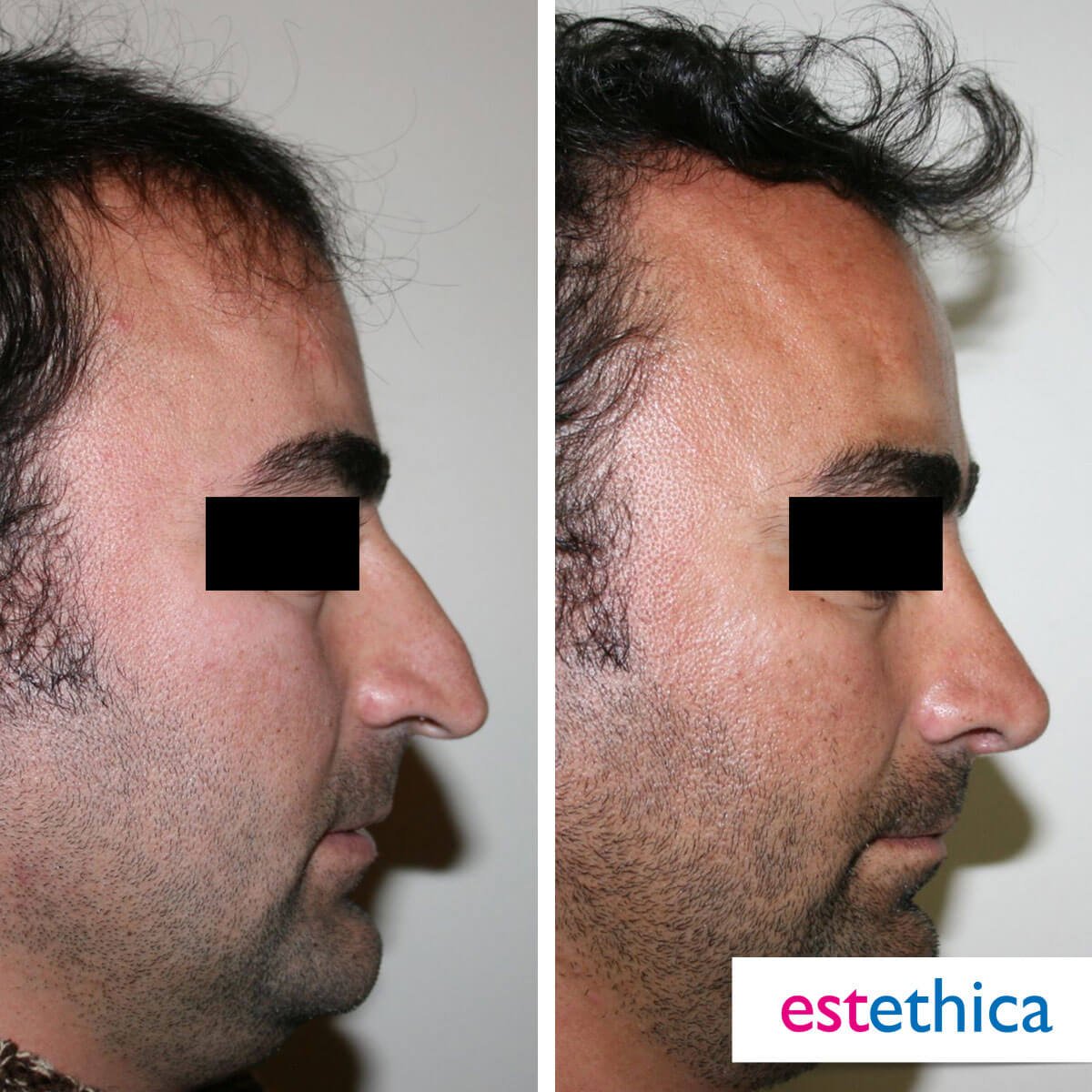Rhinoplasty Turkey Before After - Septoplasty