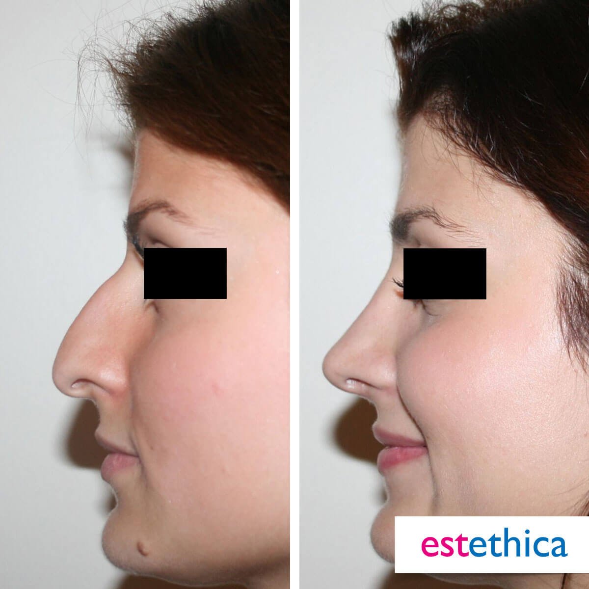 Rhinoplasty Turkey Before After - Alar Reduction